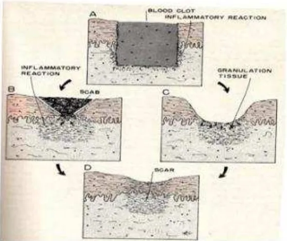 Gambar 2.3 Penyembuhan sekunder 