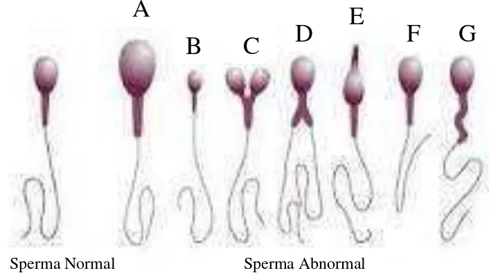 Gambar.4 Sperma abnormal pada manusia (A, kepala besar), (B, kepala kecil), (C,       kepala bercabang), (D, ekor Bercabang), (E, kepala meruncing), (F, ekor       bengkok), (G, leher bengkok) (Anonim c, 2013)