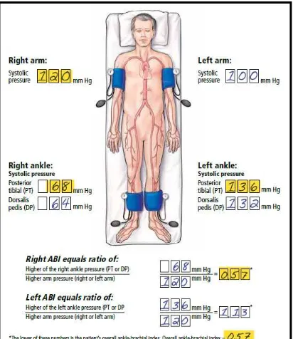 Gambar 2.5. Cara perhitungan ABI (Ankle Brachial Index) 