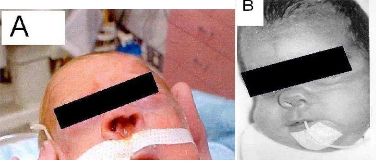 Gambar 1. A. Erosi septum nasi, B. Nasal snubbing akibat CPAP