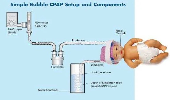 Gambar 3. Contoh Penggunaan Bubble CPAP