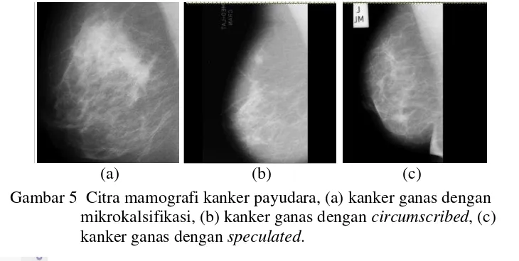 Gambar 5  Citra mamografi kanker payudara, (a) kanker ganas dengan 