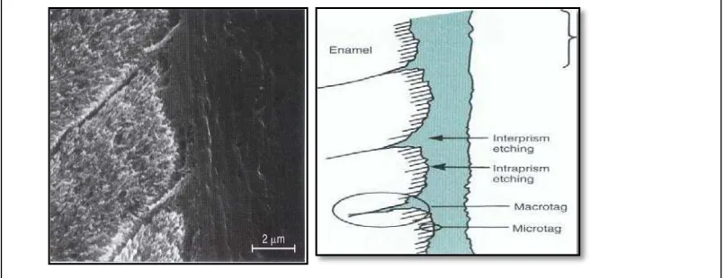 Gambar 5. Scanning Electron Microscopy ruang intertubular dan tubulus dentin yang terbuka pada dentin yang dietsa (A)