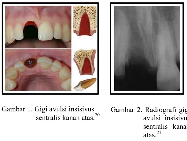 Gambar 1. Gigi avulsi insisivus sentralis kanan atas.20