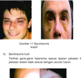 Gambar 11 Barotrauma  wajah  
