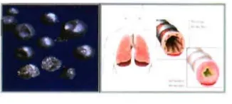 Gambar 8. Beriliium dan gambaran paru pada Chronic 