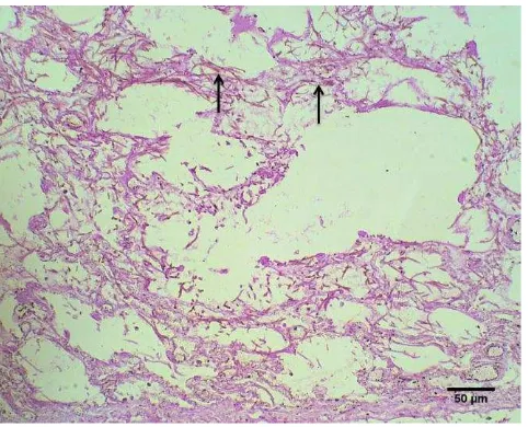 Gambar 4  (A). Edema paru-paru, dengan cairan berwarna pink dalam alveol (panah), dan emfisema (bintang); (B)