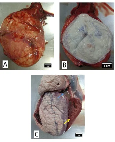 Gambar 1 (A) Perikardium menebal dan mengalami serous atrofi; (B) Gout viseralis jantung; (C) Gout viseralis, kardiomiopati (panah kuning), chicken fat clot dan blood clot (panah biru) di kedua ventrikel 