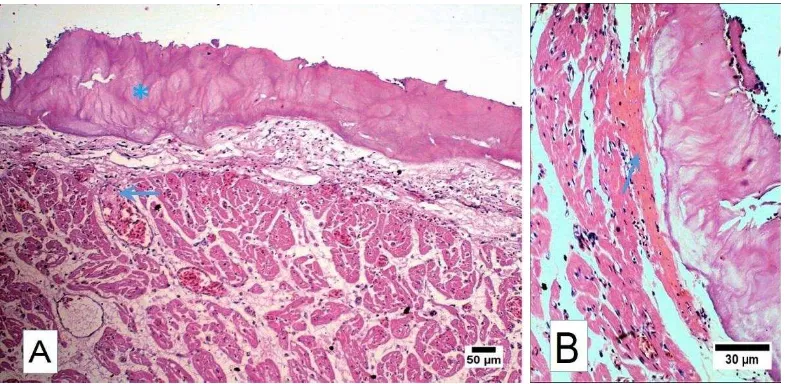 Gambar 8 Gout viseralis di jantung. (A) Epikardium menebal (asterisk) karena akumulasi kristal urat, dan degenerasi hyalin pada otot jantung (panah); (B) Degenerasi hyalin dan nekrosa miokardium (panah)