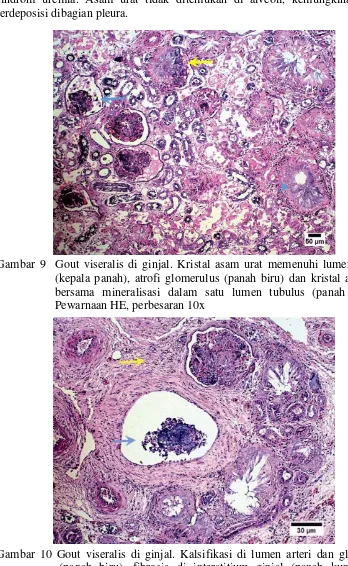 Gambar 10 Gout viseralis di ginjal. Kalsifikasi di lumen arteri dan glomerulus (panah biru), fibrosis di interstitium ginjal (panah kuning) dan deposit kristal asam urat di lumen tubulus (asterik)