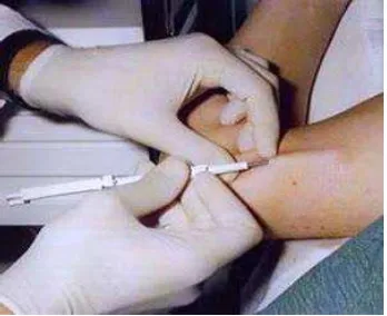 Gambar 5. Teknik Pemasangan Implant (Kusmarjadi, 2011) 