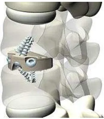 Figure 2.1 Example of stand-alone anterior lumbar fusion cage 