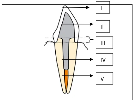 Gambar 6. Restorasi gigi berpasak dengan preparasi ferrule.  (I) mahkota, (II) inti, (III) ferrule, (IV) pasak, (V) gutta-percha7 