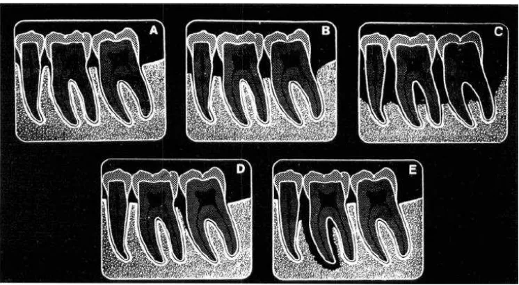 Gambar 5.  Diagram ilustrasi variasi gambaran radiografik periodontitis. A. Awalnya terdapat 