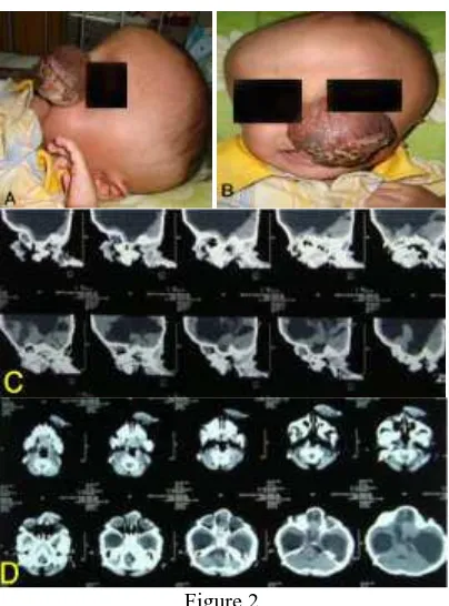 Figure 3  A) and B) This baby girl demonstrates the  features 