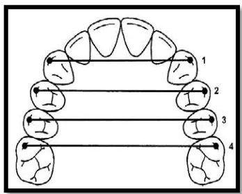 Gambar 5. Metode pengukuran lebar lengkung gigi menurut Isik dan   Narbantgil29 