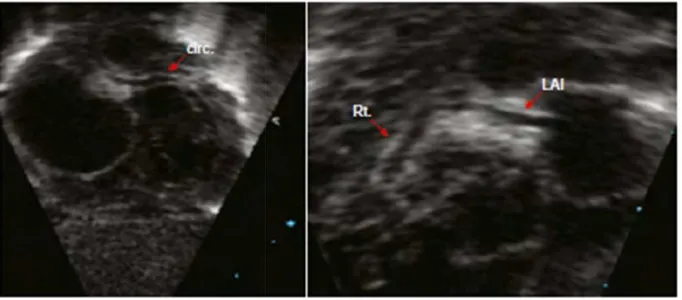 Gambar 16.Diagram a. koronadescending artery; LCCA, left circuDikutip dari: Park MK3ronaria, pada pandangan sumbu pendek parastercircumflex coronary artery; RCA, right coronary artery.asternal LAD, left anteriorrtery.