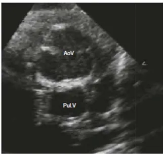 Gambar 14.pandangan sumbu pposteriorbu pendek parasternal, aorta dan arteri pulmonalinalis dalam posisi antero