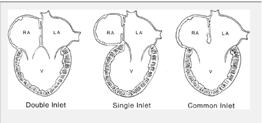 Gambar 1. Klasifikasi univentricle berdasarkan hubungan katup AV dengan ventrikel. 1