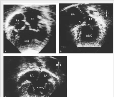 Gambar 2. Ekokardiografi pada a) double inlet ventricle, B) single inlet ventricle dan C)