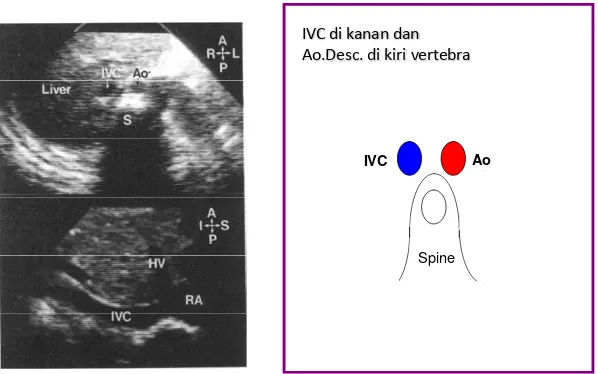 Gambar 4. Situs solitus, vena kava inferior di kanan aorta desenden di kiri vertebra