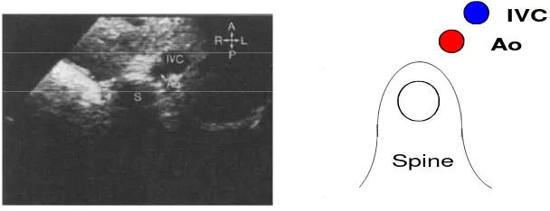 Gambar 6. Situs ambigus vena kava inferior di anterior-lateral, aorta desenden berjalan