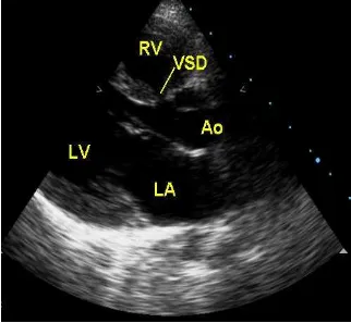Gambar 1. Pandangan Sumbu Panjang Parasternal pada tetralogy fallotKeterangan: RA (right atrium), RV (right ventricle), LV (left ventricle), LA (leftatrium), RV (right ventricle), Sinus coronaries, MV (mitral valve) dan AV (aortavalve), LV (left ventricle)