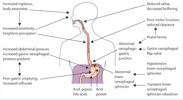 Figure 1. Pathophysiology og gastro-oesophageal reflux disease 1