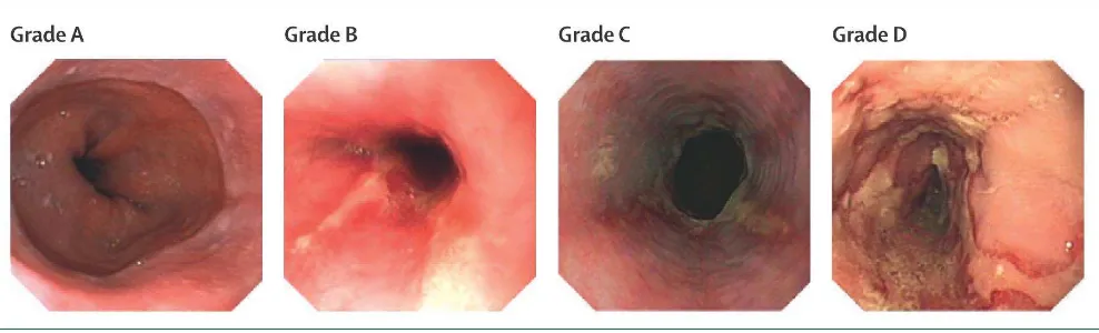 Figure 2. Los Angles classification of reflux oesopahgitis 1