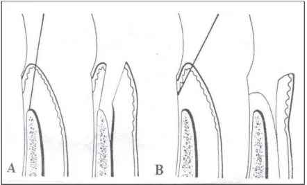 Gambar A Full Thickness, Gambar B Partial Thickness