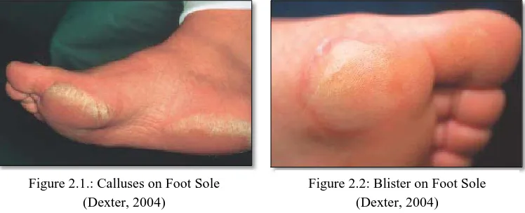 Figure 2.1.: Calluses on Foot Sole (Dexter, 2004) 