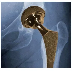 Figure 2.1: Feature of metal implant 