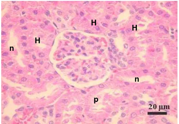Gambar 6 Tubulus ginjal tikus yang mengalami degenerasi hidropis (H), nekrosa (n) dan endapan protein di lumen (p) pasca pemberian daun A.villosa selama 4 minggu