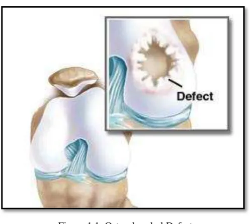 Figure 1.1: Osteochondral Defect 