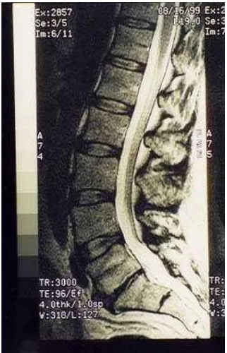 Figure 2.4 MRI of lumbar spine with degenerative disc disease (DDD) at L5-S1. 