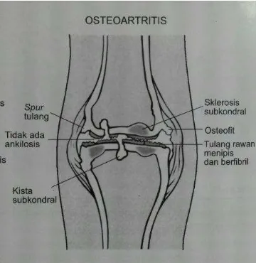 Gambar. 3. Gambaran Osteoartritis (Price dan Wilson, 2013). 