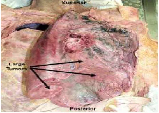 Gambar 2. Organ Paru-Paru dengan Kanker (Greene et al, 2002).