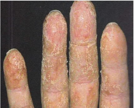 Gambar 4. Dermatitis Kontak Iritan Kronis  