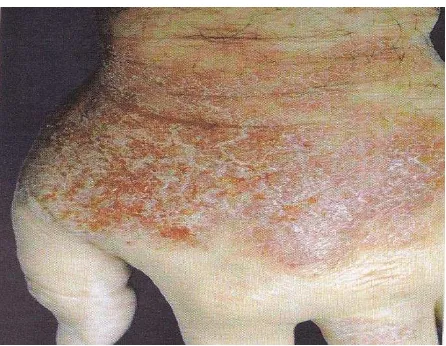 Gambar 5. Dermatitis Kontak Alergik  