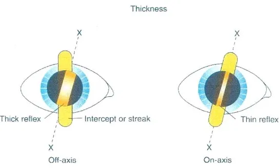 Gambar 4 : Width / lebar atau ketebalan, refleks retina. Kita tentukan lokasi aksis di 