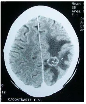 Gambar 9. Oedema cerebral Sumber: http://en.wikipedia.org 
