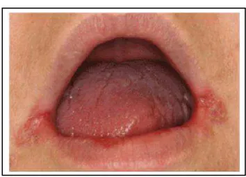 Gambar 2.  Angular cheilitis 19