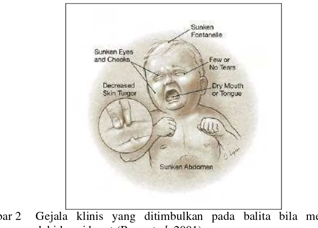 Gambar 2 Gejala klinis yang ditimbulkan pada balita bila mengalami 