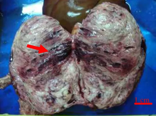 Gambar 1 Massa tumor pada hati. 