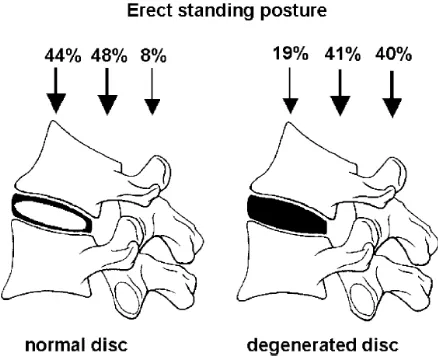 Figure 1. 15: : Load sharing in lumbar spine in normal and degeneration disc. 