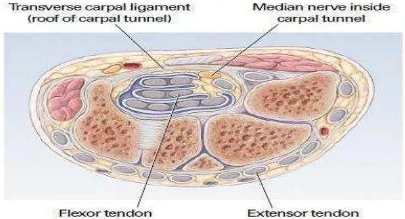 Gambar 1. Carpal Tunnel Syndrome  (Sumber: The New England Journal of Medicine) 