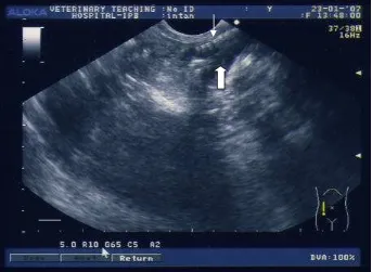Gambar 12  Sonogram dari kasus macerasi yang menunjukkan adanya tulang fetus   yang ditunjukkan panah putih biasa, mengapung dalam cairan amnion (tanda panah putih tebal)