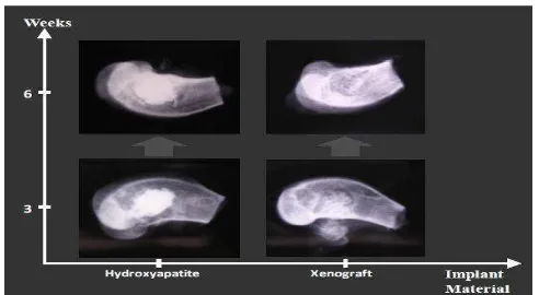 Gambar 2.4 Radiologi dari HA (kiri) dan xenograft tulang sapi (kanan) yang memperlihatkan bahwa xenograft lebih bioresorbable dibandingkan HA