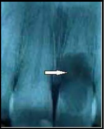 Gambar 1. Resorpsi internal pada gigi depan atas.5  