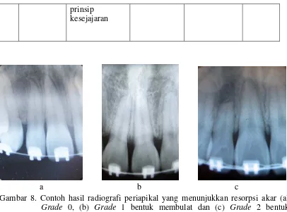 Gambar 8. Contoh hasil radiografi periapikal yang menunjukkan resorpsi akar (a) 